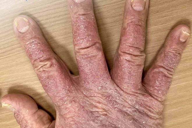 Trầm cảm, tự ti vì bệnh vảy nến