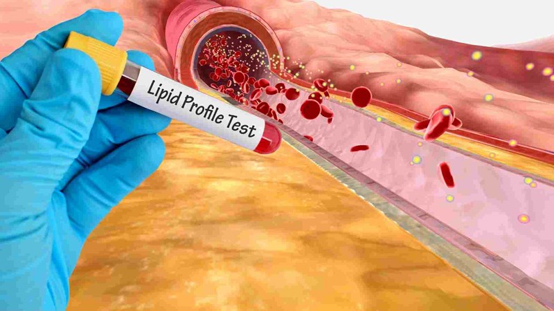Người có lipid máu cao thường xuất hiện một số dấu hiệu ở mắt. Đồ họa: Hạ Mây