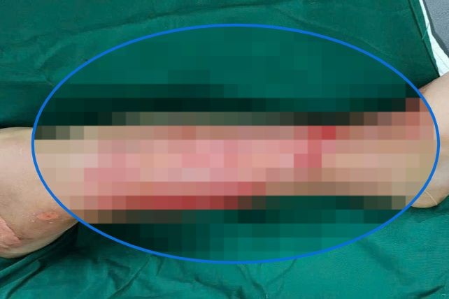 Vết thương của một bệnh nhân tự dùng thuốc điều trị bỏng (Ảnh: BVCC)