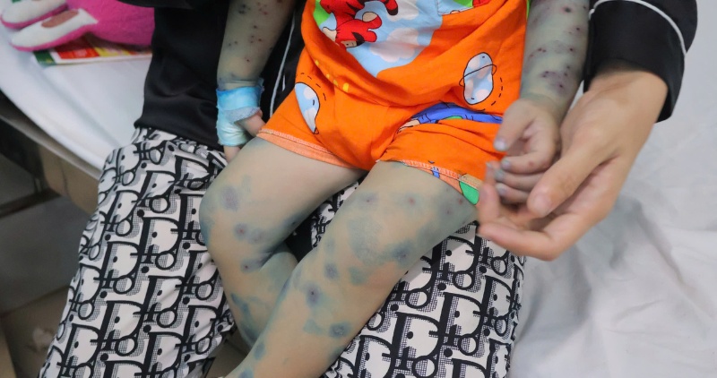 Phụ huynh lo lắng khi con xuất hiện dấu hiệu tay chân miệng trong thời điểm đầu năm học, nguy cơ bệnh lây lan cao. Ảnh: Hoàng Lộc