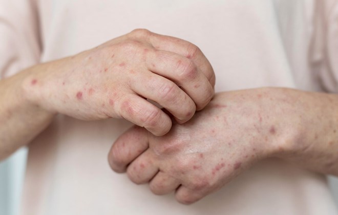 Bệnh Mpox lây lan như thế nào