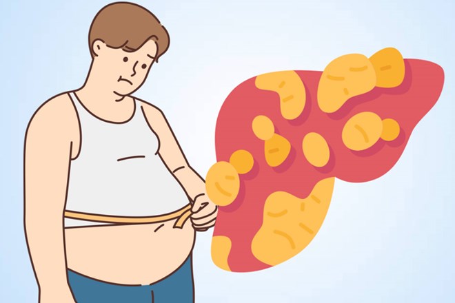 Tăng cân đột ngột có thể là dấu hiệu của bệnh gan nhiễm mỡ