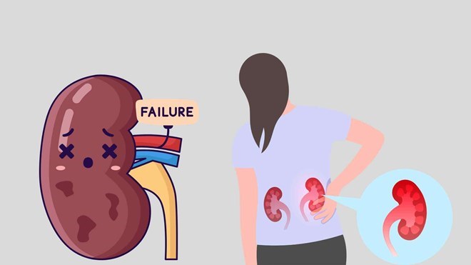 Bác sĩ cảnh báo việc chị em dễ nhầm giữa sỏi thận và đau bụng kinh