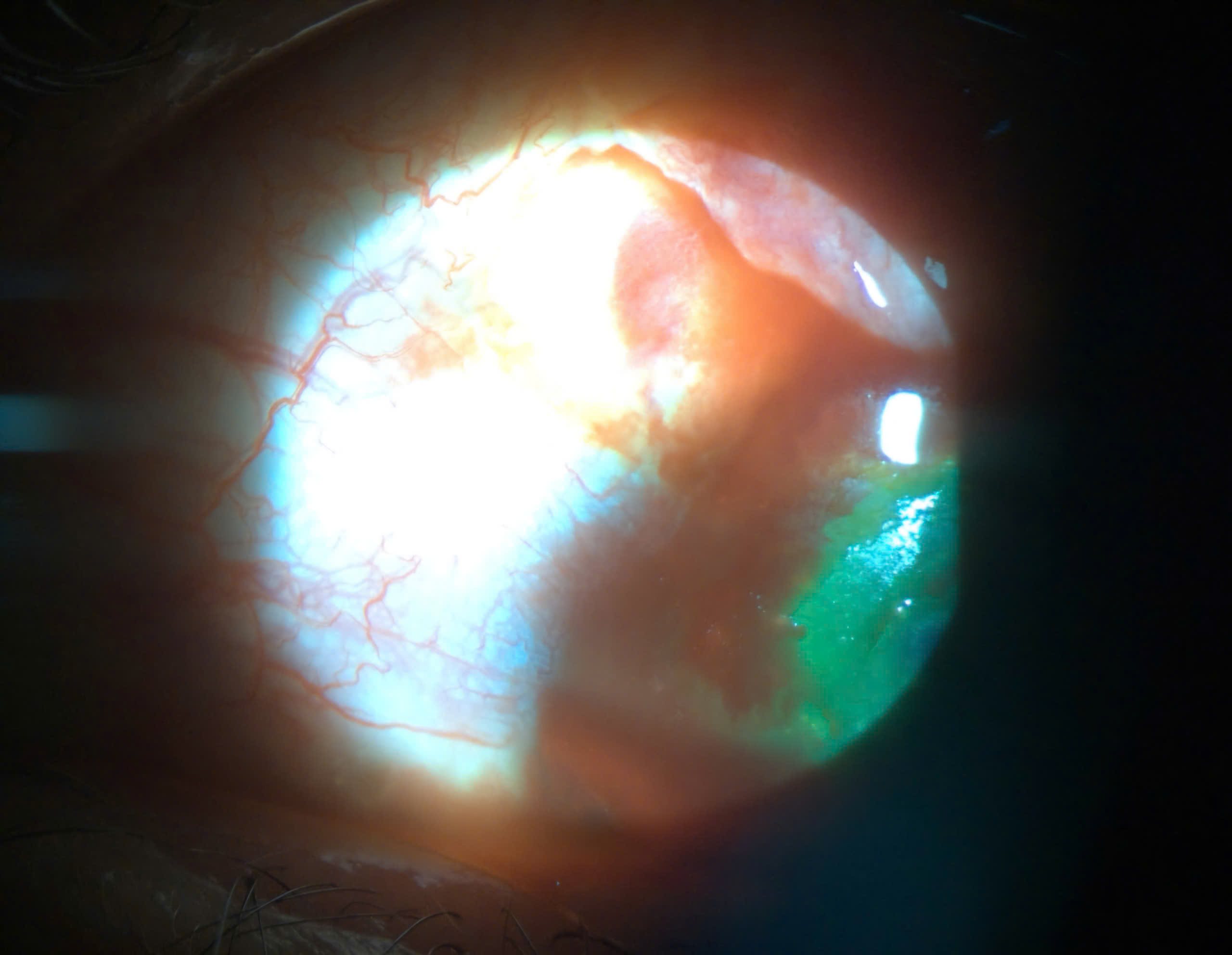 Một trường hợp bị rách giác mạc do gặp tai nạn lúc hái cà phê đến bệnh viện điều trị. Ảnh: Bệnh viện Mắt Sài Gòn Đà Lạt